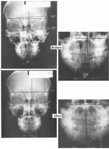 Foto do cranio antes (before) e o depois (antes) do TQ